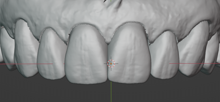 Smile example 1 - after